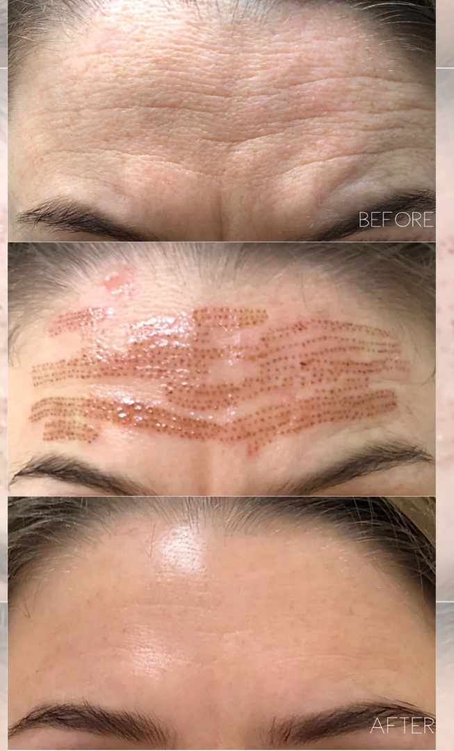 Plasma Fibroblast Therapy